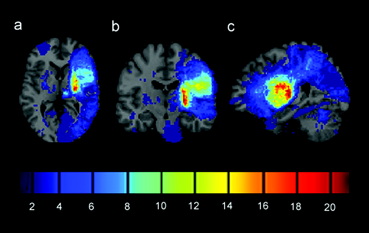 CI THERAPY, TERAPIA DE INDUCCIÓN DEL MOVIMIENTO POR RESTRICCIÓN: EVIDENCIA CIENTÍFICA Y CLÍNICA EN NEUROREHABILITACIÓN. PARTE 2.